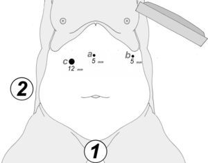 Posición del cirujano (1) y del asistente (2); posicionamiento de los puertos: (a): óptica de 5mm; (b): ultracisión de 5mm/sujetador; (c): grapadora/sujetador.