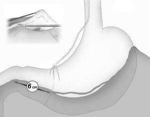 Límite distal de la maga: 6cm proximal al píloro, en el nivel de la tercera rama del nervio de Letarget.