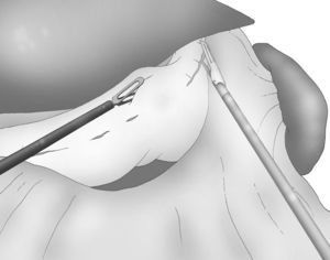 Tracción de la curvatura mayor y disección de los vasos gástricos cortos.
