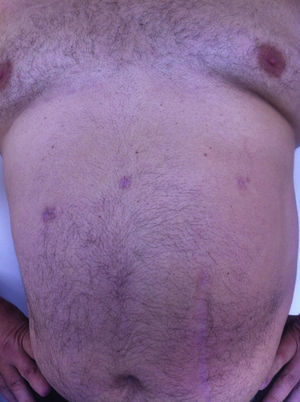 Cicatrices de GVLTP alrededor del sexto mes posoperatorio.