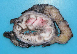 Superficie de corte transversal de adenocarcinoma (ADC) originado en la mucosa del tramo superior del canal anal con crecimiento circunferencial y endoluminal.