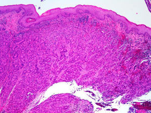 Proliferación glandular tubular desordenada e infiltrativa, subyacente a mucosa anal escamosa no neoplásica en biopsia endoscópica de un ADC de glándulas anales (hematoxilina y eosina × 10).
