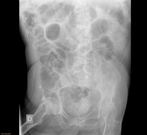 Imagen inicial de un cuadro de oclusión intestinal adherencial.