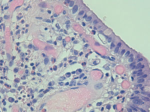 Infiltrado inflamatorio de predominio eosinofílico en el espesor de la pared vesicular. Imagen de microscopía óptica (Hematoxilina-Eosina) ×40.