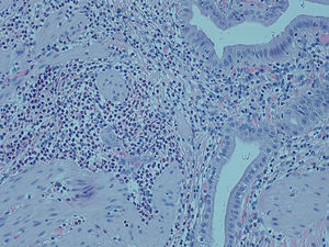 Infiltrado inflamatorio de predominio eosinofílico en el espesor de la pared vesicular. Imagen de microscopía óptica (Hematoxilina-Eosina) ×20.