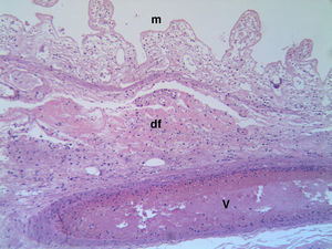 Microfotografía que muestra detalle histológico de la mucosa necrosada (m) con pérdida total del epitelio, depósitos fibrinoides (df) en la submucosa y vénula trombosada (v). Hematoxilina-eosina ×100.
