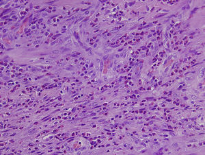 Detalle del infiltrado inflamatorio con numerosos eosinófilos. H-E 40x