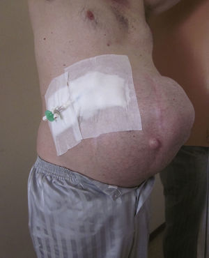 Paciente con gran hernia incisional con pérdida del domicilio, antes de la intervención.