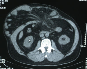 Corte axial de tomografía computarizada en el que se evidencia más del 50% del contenido abdominal fuera del abdomen, en el saco herniario.