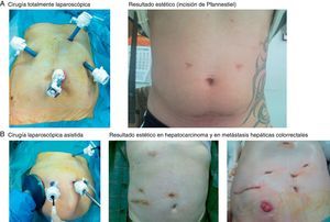 Posición de los trocares en cirugía totalmente laparoscópica (CTL) y en cirugía laparoscópica asistida (CLA), con el resultado estético. A) Cirugía CTL y resultado estético (incisión de Pfannestiel). B) CLA, resultado estético en hepatocarcinoma y en metástasis hepáticas colorrectales.