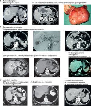 Imágenes de algunos tumores de nuestra casuística. A) Tumores benignos. 1) Hemangioma atípico. 2 y 3) Tumor desmoplásico de células fusiformes en nidos (pieza quirúrgica de HI). B) Tumores malignos primarios. 1) Hepatocarcinoma sobre cirrosis con QME. 2) Hepatocarcinoma sobre hígado sano con quimioembolización preoperatoria. 3) Colangiocarcinoma intrahepático que requirió hepatectomía izquierda por CTL. C) Metástasis hepáticas. 1) Tumor neuroendocrino de cuerpo y cola de páncreas con metástasis hepática en segmento viii. 2) MHCCR con 2 lesiones en lóbulo derecho que precisó de hepatectomía derecha por CLA.