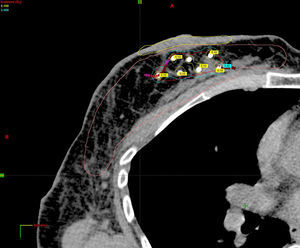 Planificación de la dosimetría con tomografía axial computarizada 3D.