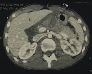 Tomografía abdominopélvica: hipodensidad pancreática, aumento del cuerpo pancreático con infiltación de la grasa, hallazgos que hacen sospechar una sección completa del cuerpo pancreático.