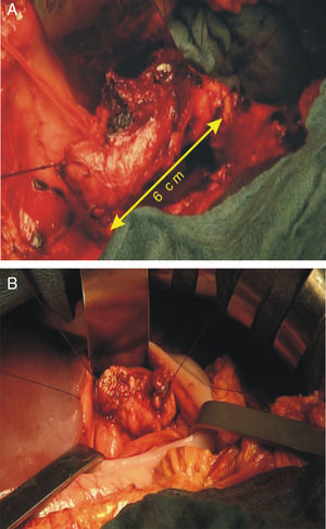 A y B) Vista intraoperatoria: sección completa del conducto de Wirsung a nivel del istmo pancreático y hemorragia activa de la arteria pancreática dorsal. Sección pancreática a nivel del istmo después de la confección de la anastomosis pancreaticogástrica.