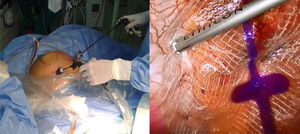 Posición de los trocares abdominales y visualización laparoscópica de la fijación de la malla.
