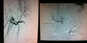 Seudoaneurisma que se rellena a partir de ramas de la arteria hepática derecha, arterias de los segmentos vii y viii. Se realiza embolización endovascular mediante coils. Imagen de la derecha: arteriografía donde no se evidencia fuga de contraste tras embolización.