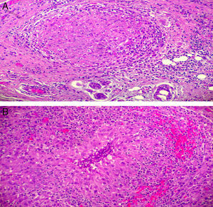 A) Granuloma no caseificante formado por histiocitos epiteloides que se encuentran rodeados de linfocitos y de células plasmáticas (HE, 100x); B) Granuloma necrotizante: foco de necrosis central rodeado de histiocitos epiteloides en empalizada, linfocitos y células plasmáticas (HE; 100x).