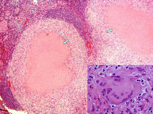 Anatomía patológica. Ganglio linfático con granulomas y áreas de necrosis (flechas). Vista de una célula gigante. Tinción hematoxilina eosina x40.