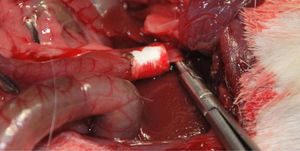 Interposición de la prótesis utilizando suturas de reabsorción lenta de ácido poliláctico.