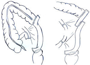 Interposición de intestino delgado (un asa o 2) entre el colon y el recto.