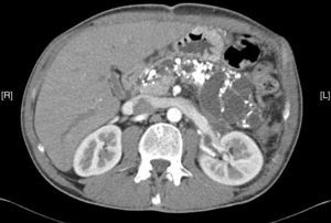 Imagen de tomografía computarizada c n dilatación del conducto de Wirsung, calcificaciones y lesión quística en cuerpo y cola de páncreas.