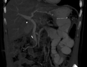 TAC abdomino-pélvica con contraste intravenoso posquirúrgico (fase portal). Prótesis portal de goretex, con adecuado relleno y flujo, sin extravasación de contraste a nivel anastomótico. Oncológicamente, sin evidencia de enfermedad.