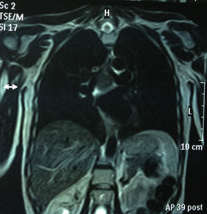 RMN de tórax (secuencia T1, corte coronal): masa mediastínica de 45mm subcarinal hiperintensa en T1.
