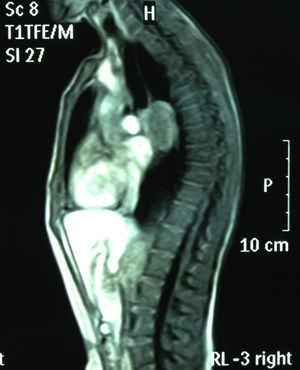 RMN de tórax (secuencia T1, corte sagital): masa mediastínica de 45mm subcarinal hiperintensa en T1.