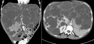 Imagen radiológica de poliquistosis hepática mediante TAC. Corte axial y coronal.
