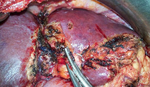 Imagen intraoperatoria de la segunda intervención donde se observa el surco del torniquete a la derecha de la cisura umbilical.