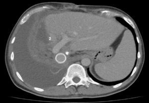 Tomografía computarizada de control a los 20 meses de la intervención donde se observa el sector lateral izquierdo hipertrofiado, el injerto de goretex permeable y la ausencia de recidiva tumoral.