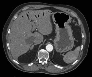 TAC abdomino-pélvico con contraste intravenoso: neumatosis portal a nivel hepático.