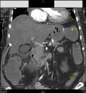 Corte sagital de TC en el que se aprecia la colecistitis enfisematosa y una trombosis total de la arteria renal izquierda.