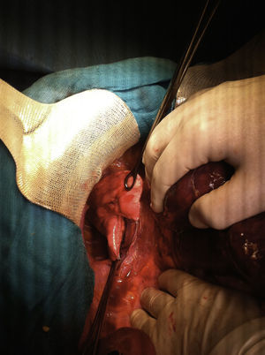 Sección de la base pulmonar con endograpadora.