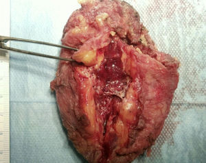 Exéresis de tumoración ovalada en el seno del músculo serrato.