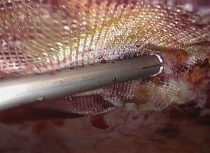 Fijación mecánica inicial (Secure strap®) para asegurar el contacto de la malla con la pared abdominal posterior.