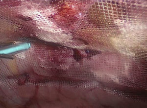 Fijación atraumática con pegamento de cianocrilato (Ifabond®) guiado por una pinza, en poca cantidad y bien distribuido para evitar su caída libre en la cavidad abdominal.