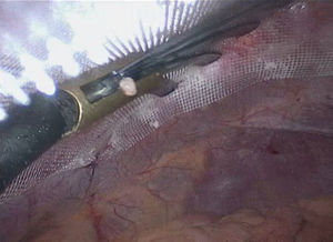 Uso del retractor hepático para asegurar una mayor superficie de contacto malla-pared abdominal posterior mientras completamos la fijación con pegamento entre sus hojas (maniobra de Moreno-Egea).