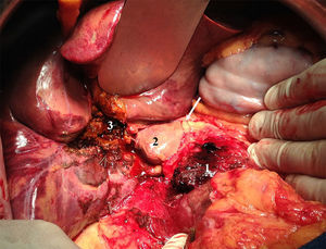 Ausencia completa de los elementos del pedículo hepático. Flecha larga: Margen de sección del ligamento gastrohepático. 1. Margen superior duodenopancreático. 2. Lóbulo caudado. 3. Zona hepática cruenta a nivel hiliar.