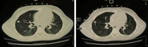 A) Localización de la lesión con tomografía axial computarizada. B) Punción con aguja guiada con tomografía axial computarizada.