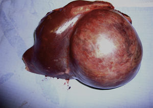 Adenoma hepático de 11cm con sangrado intratumoral en sector lateral izquierdo.