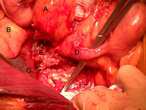 Tumoración apendicular. La pinza señala el apéndice ileocecal. A) Duodeno. B) Vesícula biliar. C) Cara inferior hepática. D) Apédice cecal. E) Tumoración originada en la punta del apéndice.