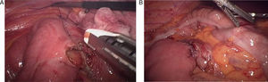 A, B) Imágenes intraoperatorias de la duodenoyeyunostomía laparoscópica.