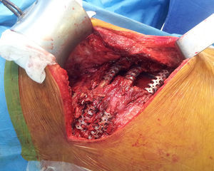 Fijación de fracturas costales con sistema STRACOS.