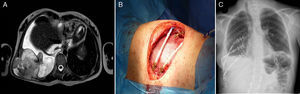 a) RMN torácica preoperatoria donde se observa lesión de grandes dimensiones. b) Visión de la prótesis flexible y ya colocadas 2 barras de STRATOS. c) Radiografía de tórax de control del postoperatorio. Obsérvese como en este caso colocamos 2 de las barras en posición cruzada.