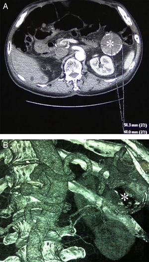 Tomografía computarizada preoperatoria. A) Imagen axial. AAE de 58×60mm. B) Reconstrucción tridimensional (*: AAE).