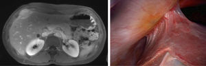 RM hepática (T1): lesión de 55×45×25mm en segmento 5 hepático con múltiples focos hemorrágicos en su interior y captación heterogénea. Imagen laparoscópica en la que se observa el implante diafragmático adherido al segmento 5 hepático.