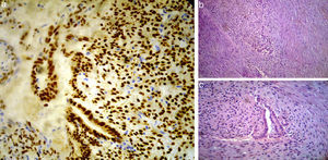 a) Inmunohistoquímica para receptores estrogénicos con positividad en los núcleos de las glándulas y del estroma. b) Glándulas endometriales con estroma endometrial en el seno de un tejido fibroso desmoplásico (HE×100). c) Glándulas endometriales con estroma endometrial en el seno de un tejido fibroso desmoplásico a mayor aumento (HE×200).
