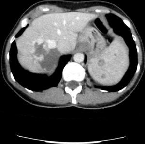 TAC: hemangiomas hepáticos y esplénicos.