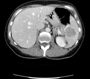 TAC: hemangiomas localizados en hilio esplénico.